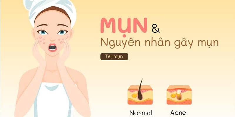 Tăng hormone thuộc 4 nguyên nhân gây mụn