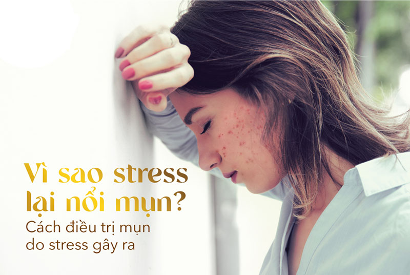 Stress cũng thuộc 4 nguyên nhân gây mụn